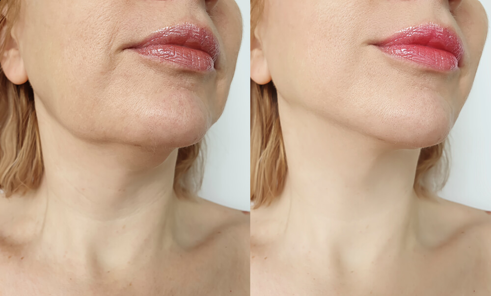 Chin Liposuction Recovery Time Painful is Double Chin Liposuction
