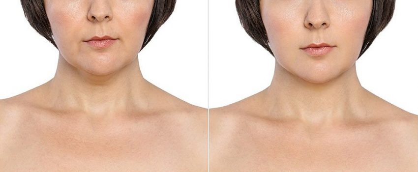 You need to make sure that your skin is as healthy and elastic as possible if you want to see your ultimate results chin liposuction after 1 week.