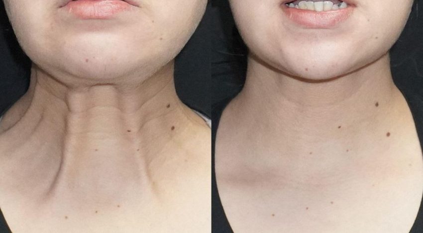 Neck Botox Before and After