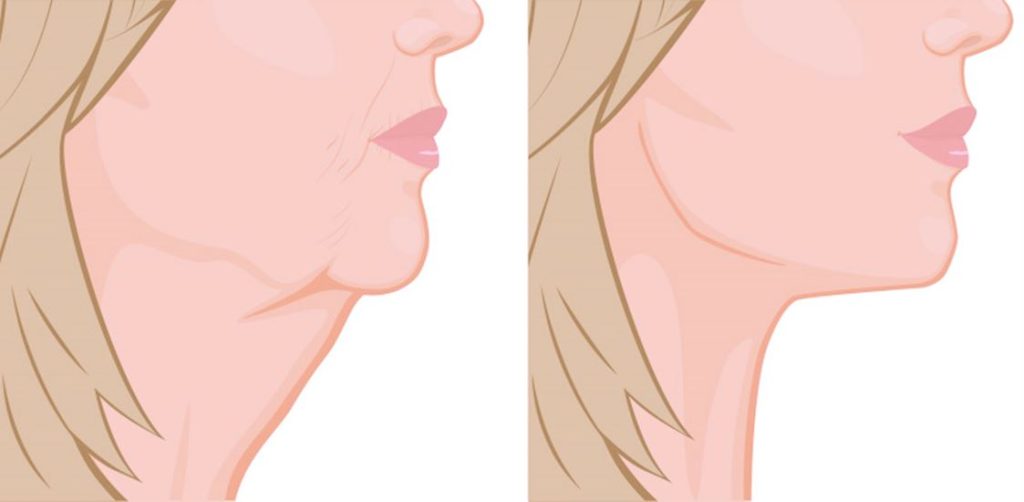 Submental Liposuction Before After Draw Vector